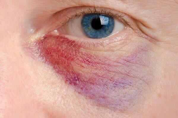 facial injury
